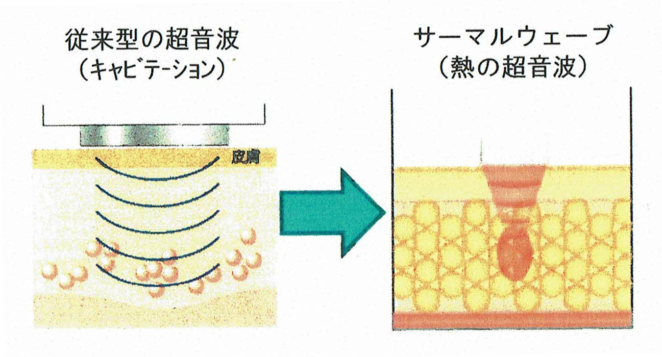 従来のキャビテーションとの違い